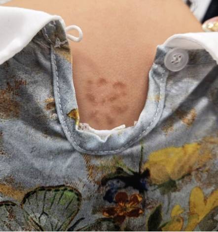 杭州5岁女孩背上惊现“梅花印”，罪魁祸首竟是家里的……